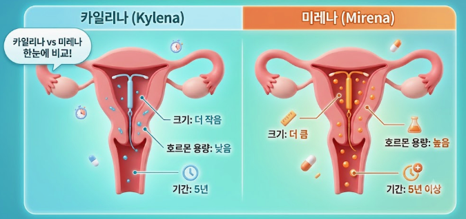 미레나와 카일리나, 나에게 맞는 피임 장치는 어떻게 고르나요? 관련 해부 구조 그림