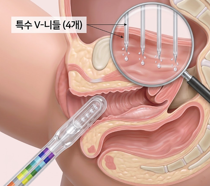 질건조증, 질소프 시술로 나아질 수 있을까요? 관련 해부 구조 그림